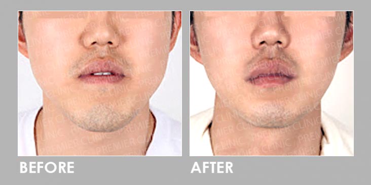 JAW BOTOX BEFORE AND AFTER