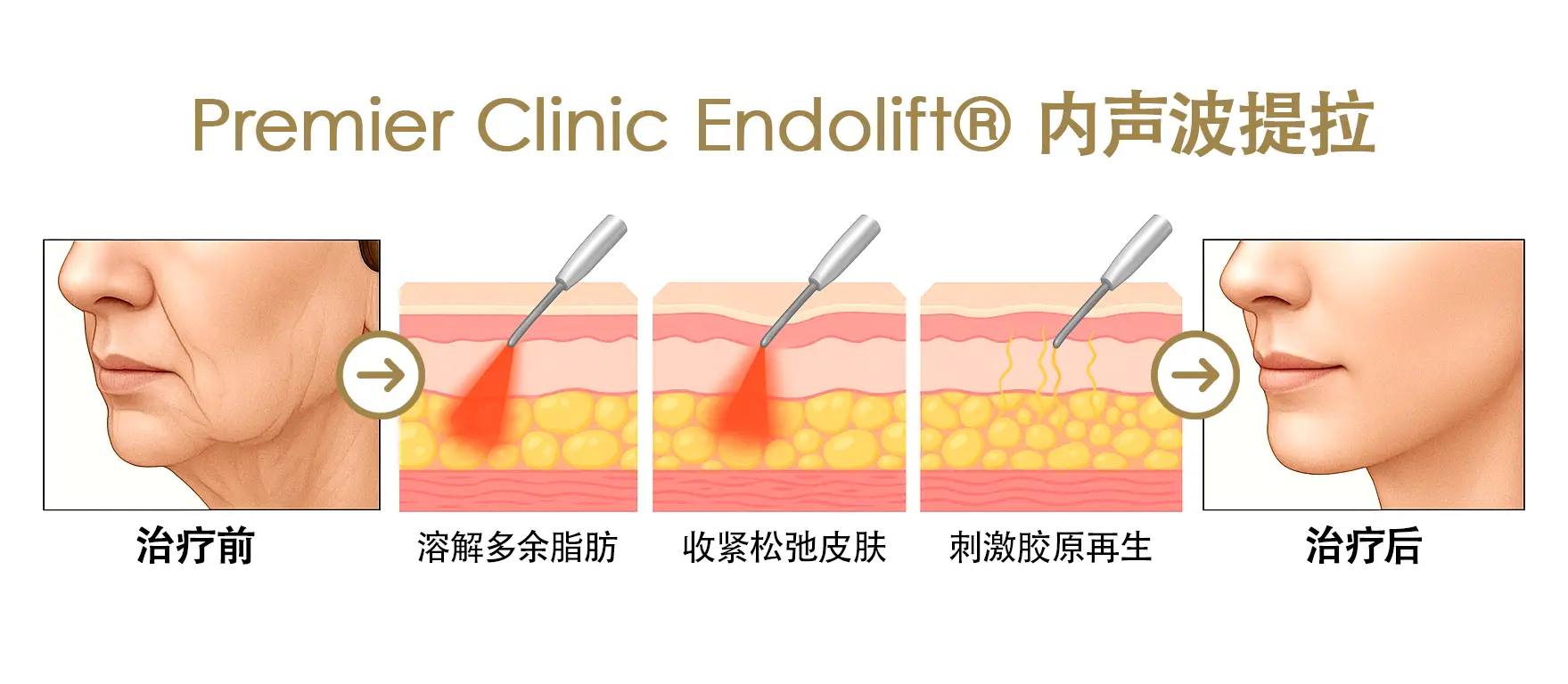 Endolift® 内声波提拉