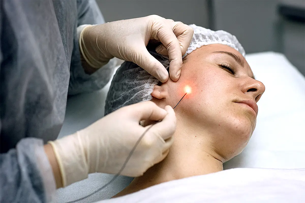 Endolift® 内声波提拉
